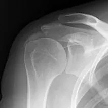 石灰沈着性腱板炎について